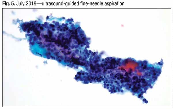 Fig. 5. July 2019—ultrasound-guided fine-needle aspiration