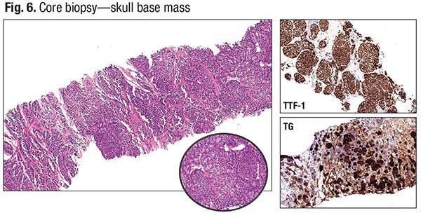Fig. 6. Core biopsy—skull base mass