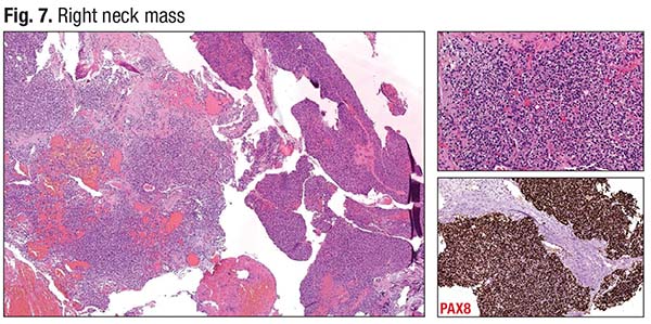 Fig. 7. Right neck mass