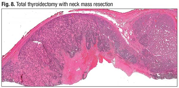 Fig. 8. Total thyroidectomy with neck mass resection