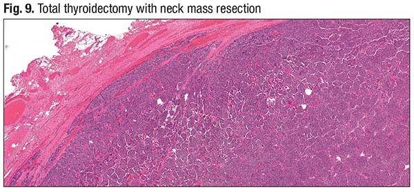 Fig. 9. Total thyroidectomy with neck mass resection