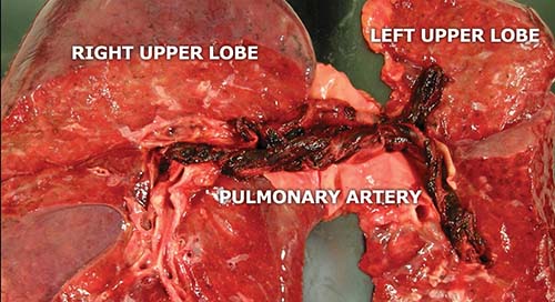 Pulmonary arterial trunk opened to reveal pulmonary saddle embolus