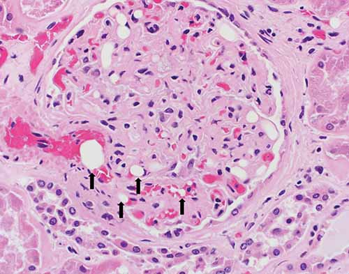 Clear round vacuoles within renal glomerular capillaries