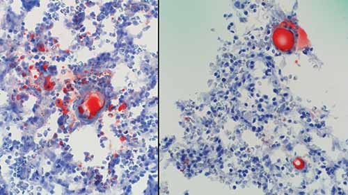 Scattered, positively staining round vacuoles within pulmonary arterial vessels on frozen section 