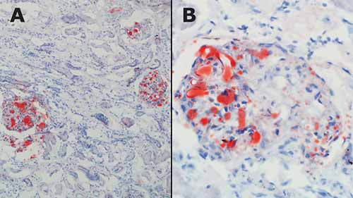 Scattered, positively staining round vacuoles within renal glomerular capillaries on frozen section