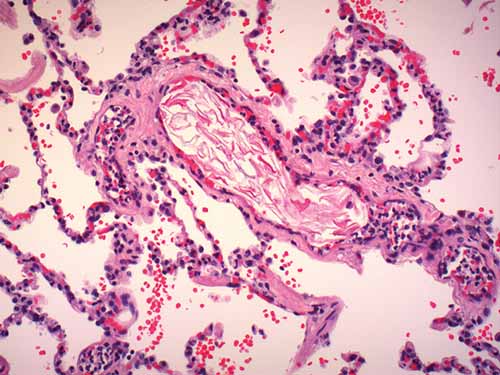 Amniotic fluid embolus with fetal squames 
