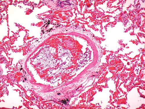 Amniotic fluid mucinous embolus 