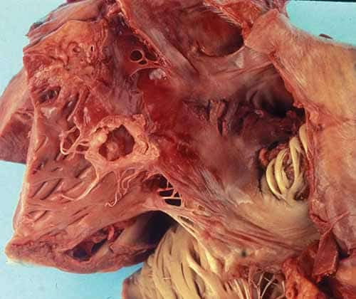 Bacterial endocarditis with perforation of tricuspid valvular leaflet