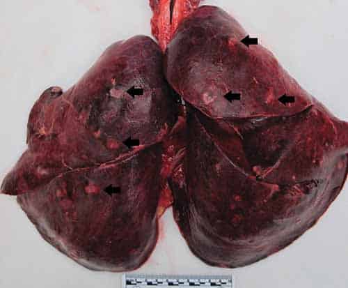 Consolidated and hemorrhagic lungs laden with yellow “cannonball” septic emboli and abscesses