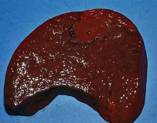 Wedge-shaped subcapsular splenic septic infarction following endocarditis