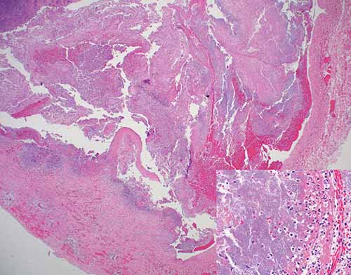 Lemierre’s Syndrome: septic thrombus within right internal jugular vein 