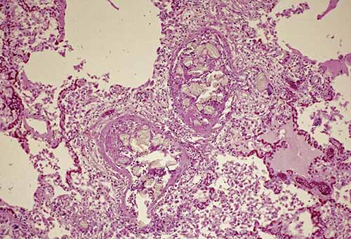 Refractile pulmonary intravascular foreign material from injection of crushed pills 