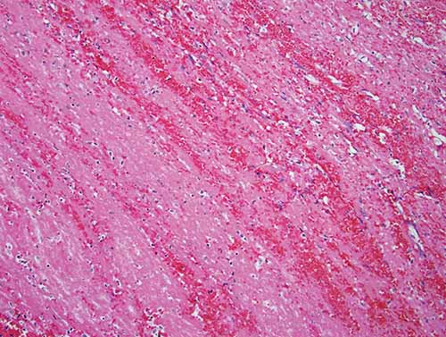 Acute pulmonary thromboembolus with alternating layers of pink fibrin with platelets and fresh red blood cells