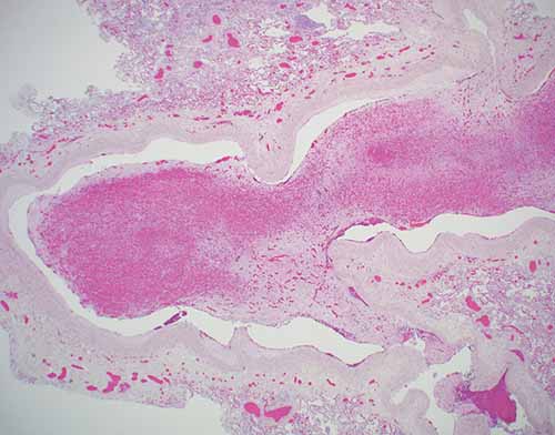 Organizing pulmonary thromboembolus with granulation tissue at site of arterial wall attachment