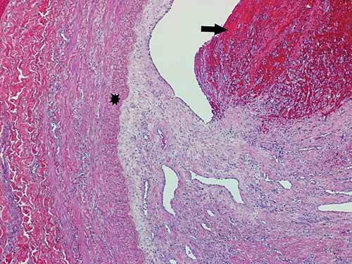 Organizing pulmonary thromboembolus with superimposed acute component (arrow) adherent to pulmonary arterial wall (star) 