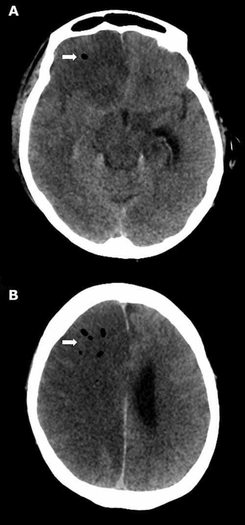 Multiple corresponding bubbles of air are seen within the parenchyma of the right cerebral hemisphere on axial non-contrast head CT in a patient who developed cerebral air embolism following lung biopsy