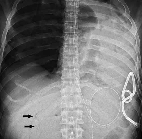 Anteroposterior chest radiograph demonstrating massive arterial air embolism