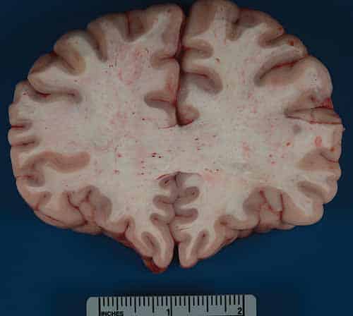 Gross image of petechiae in white matter of brain due to fat emboli