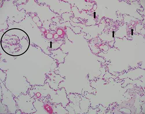 Multiple clear round vacuoles within small pulmonary arterial and capillary vessels