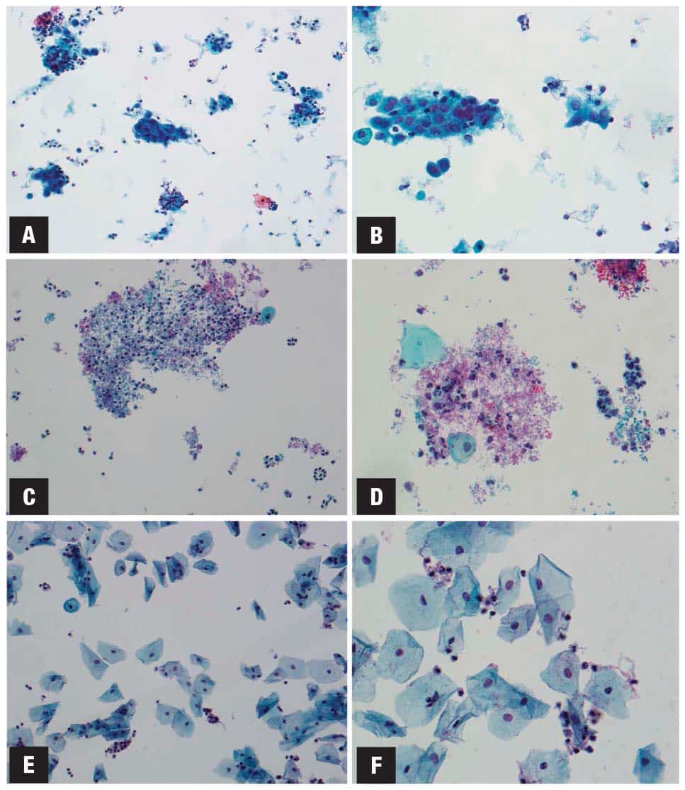 Pap tests in transgender individuals. All are Papanicolaou-stained ThinPrep preparations from patients identifying as a male gender with female sex at birth.