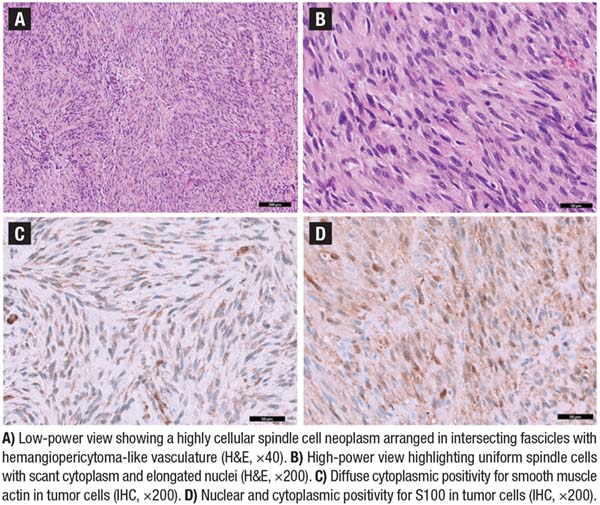 Fig. 1. Histologic and immunohistochemical features of the mediastinal mass