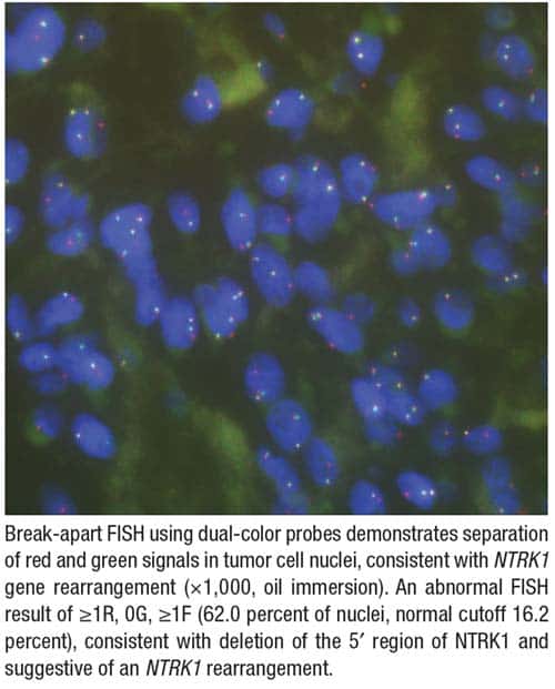 Fig. 2. NTRK1 rearrangement by fluorescence in situ hybridization