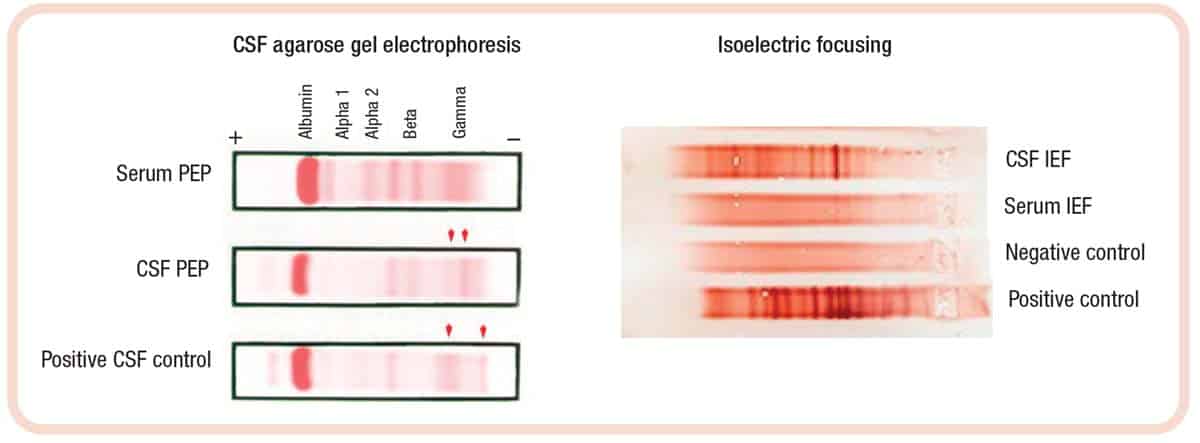 Fig. 2. Oligoclonal banding assay.CSF electrophoresis and isoelectric focusing