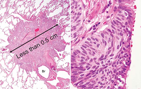 Carcinoid tumorlet