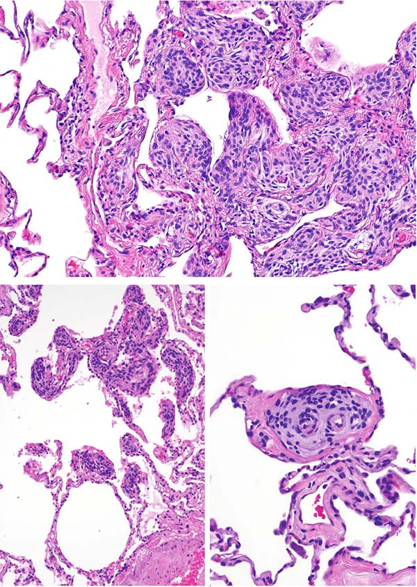 Meningothelial-like nodule