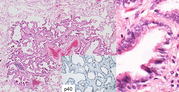 Bronchiolar metaplasia