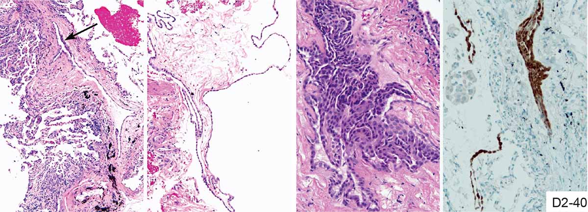 Entrapped pleural fragments and mesothelial hyperplasia