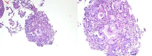 Mucinous adenocarcinoma