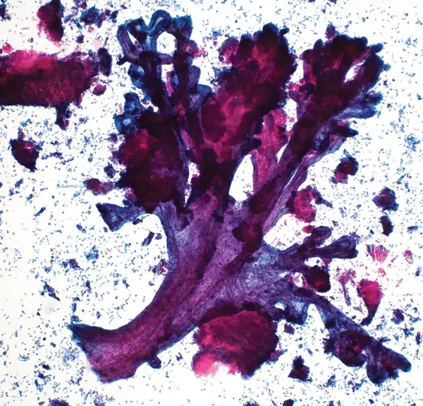 Renal pelvis washing. Pap stain, low magnification.