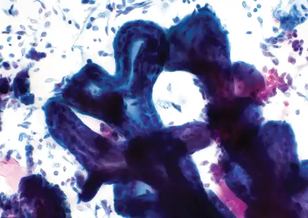 Renal pelvis washing. Pap stain, intermediate magnification.