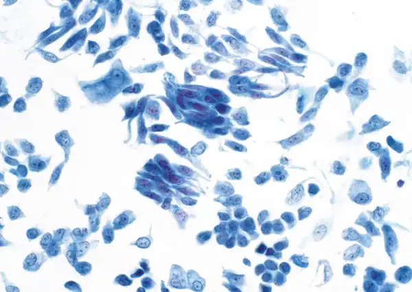 Renal pelvis washing. Pap stain, high magnification.