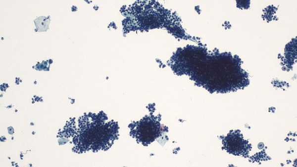 Unsatisfactory Pap due to obscuring inflammation