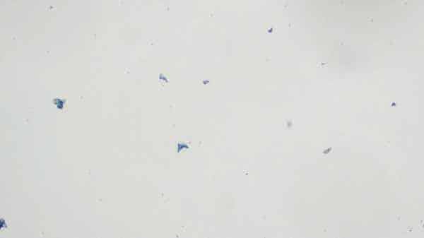 Unsatisfactory Pap due to scant cellularity