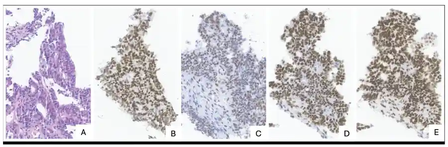 Colon adenocarcinoma (transverse colon, biopsy): H&E and MMR IHC