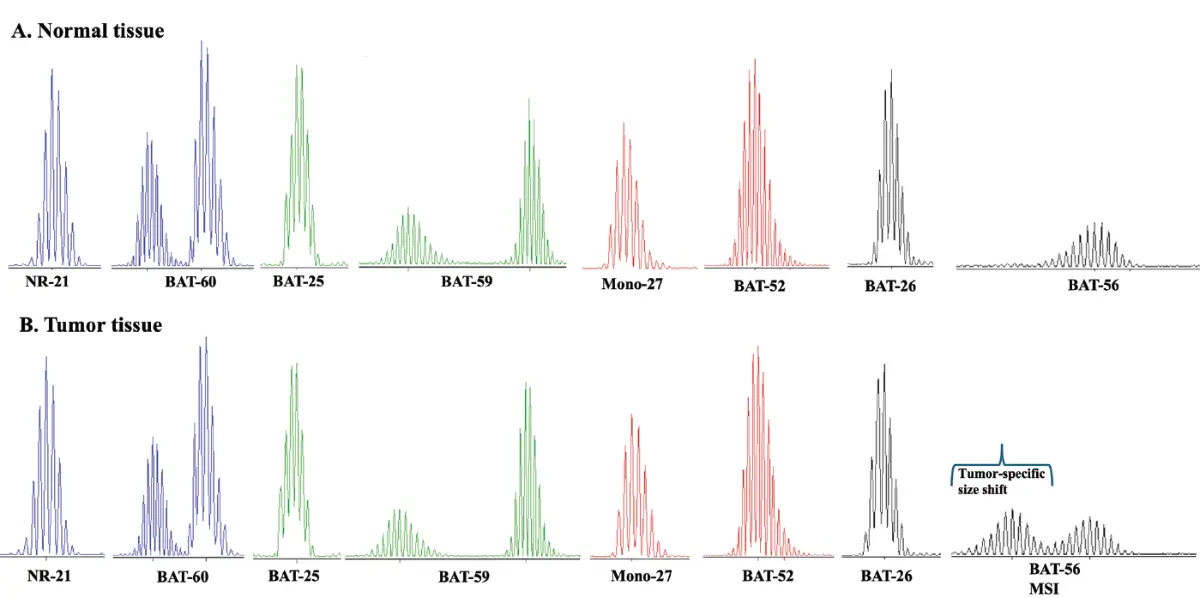 PCR-based microsatellite instability (MSI) testing results
