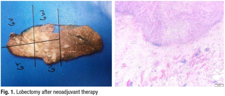 Fig. 1. Lobectomy after neoadjuvant therapy
