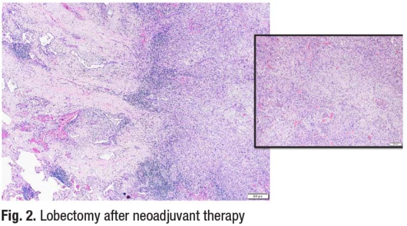 Fig. 2. Lobectomy after neoadjuvant therapy