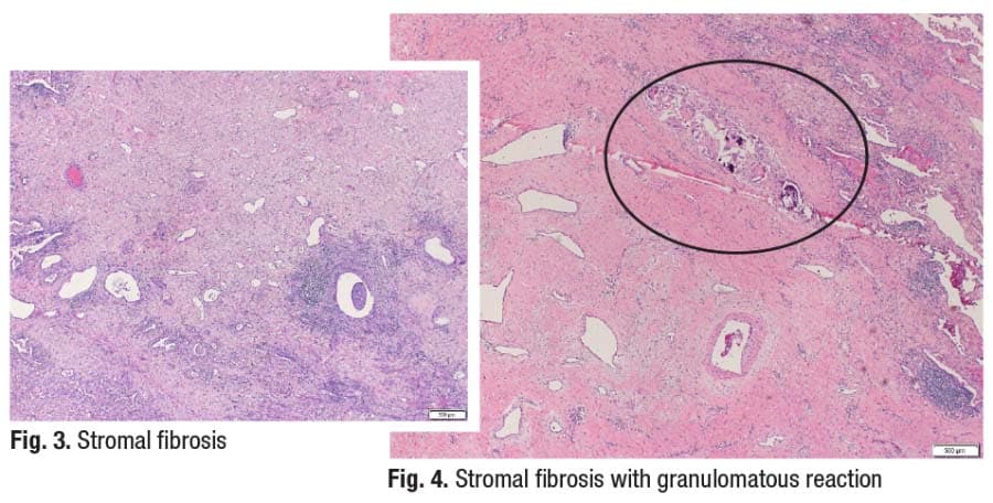 Fig. 3. Stromal fibrosis; Fig. 4. Stromal fibrosis with granulomatous reaction