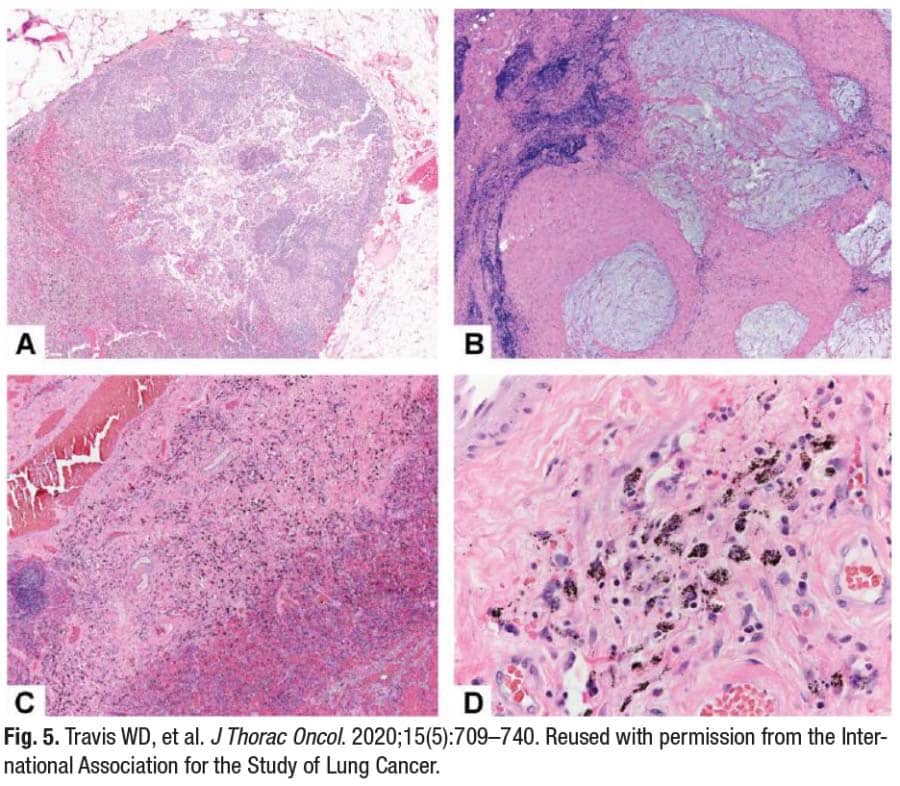 Fig. 5. Travis WD, et al. J Thorac Oncol. 2020;15(5):709–740. Reused with permission from the International Association for the Study of Lung Cancer.
