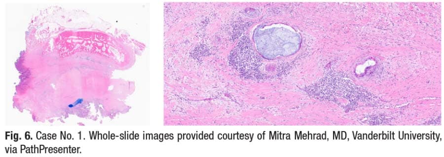 Fig. 6. Case No. 1. Whole-slide images provided courtesy of Mitra Mehrad, MD, Vanderbilt University, via PathPresenter.