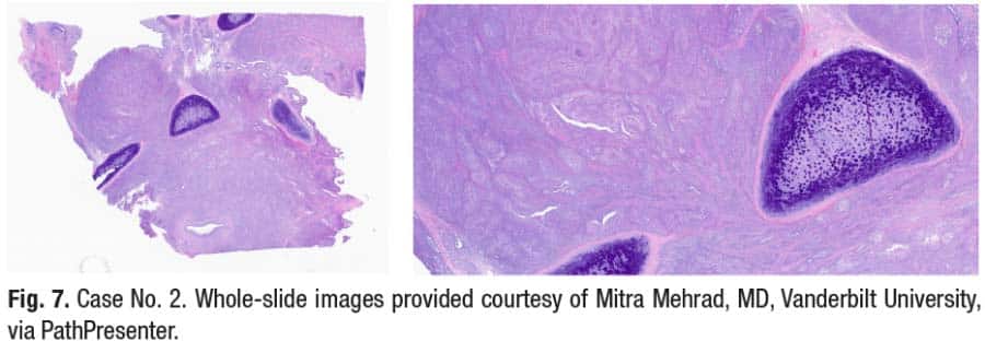 Fig. 7. Case No. 2. Whole-slide images provided courtesy of Mitra Mehrad, MD, Vanderbilt University, via PathPresenter.