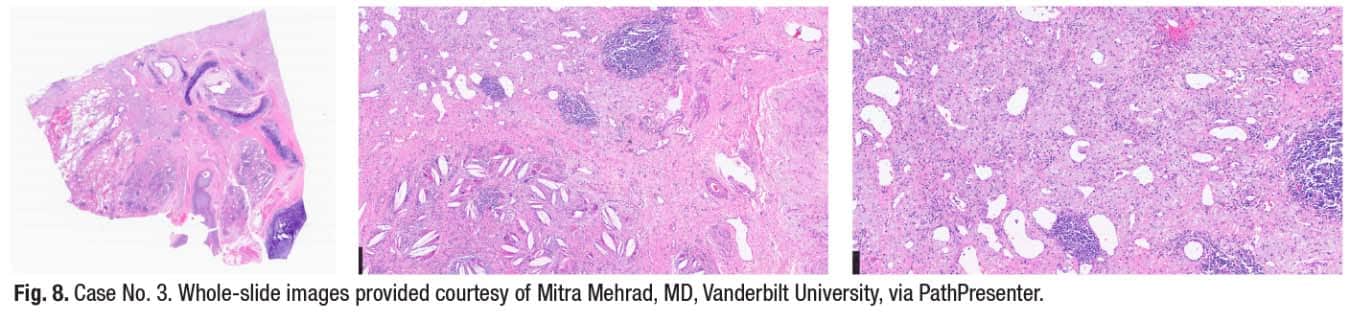 Fig. 8. Case No. 3. Whole-slide images provided courtesy of Mitra Mehrad, MD, Vanderbilt University, via PathPresenter.
