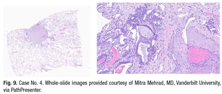 Fig. 9. Case No. 4. Whole-slide images provided courtesy of Mitra Mehrad, MD, Vanderbilt University, via PathPresenter.