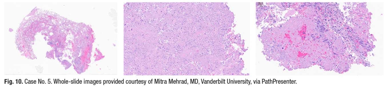 Fig. 10. Case No. 5. Whole-slide images provided courtesy of Mitra Mehrad, MD, Vanderbilt University, via PathPresenter.