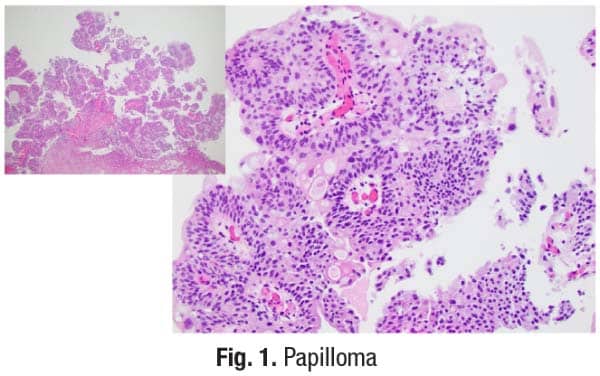 Fig. 1. Papilloma