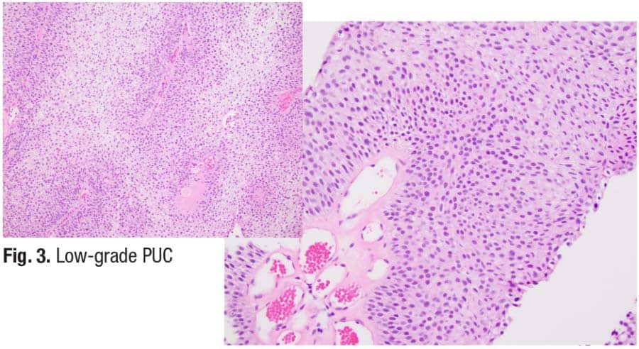 Fig. 3. Low-grade PUC
